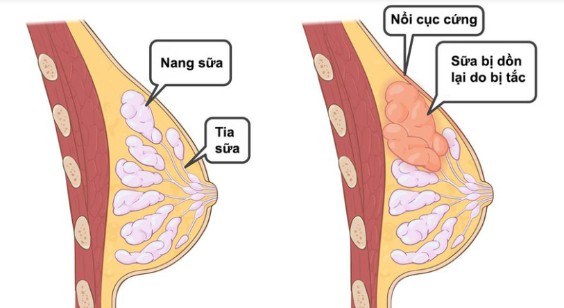 Làm thế nào để phòng và điều trị tình trạng tắc sữa ở mẹ sau sinh?